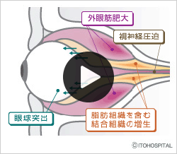 甲状腺関連眼症