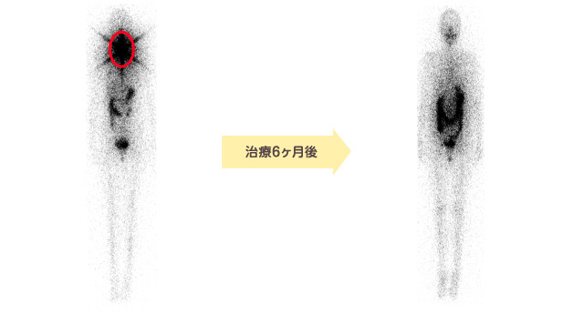 アブレーション治療後の効果判定